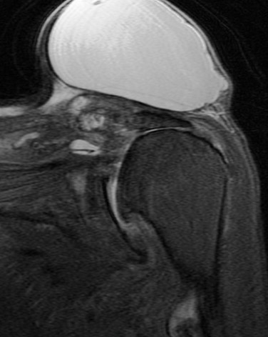 Figure 3 for case Large cyst above a degenerated acromioclavicular joint ( RID1895 )